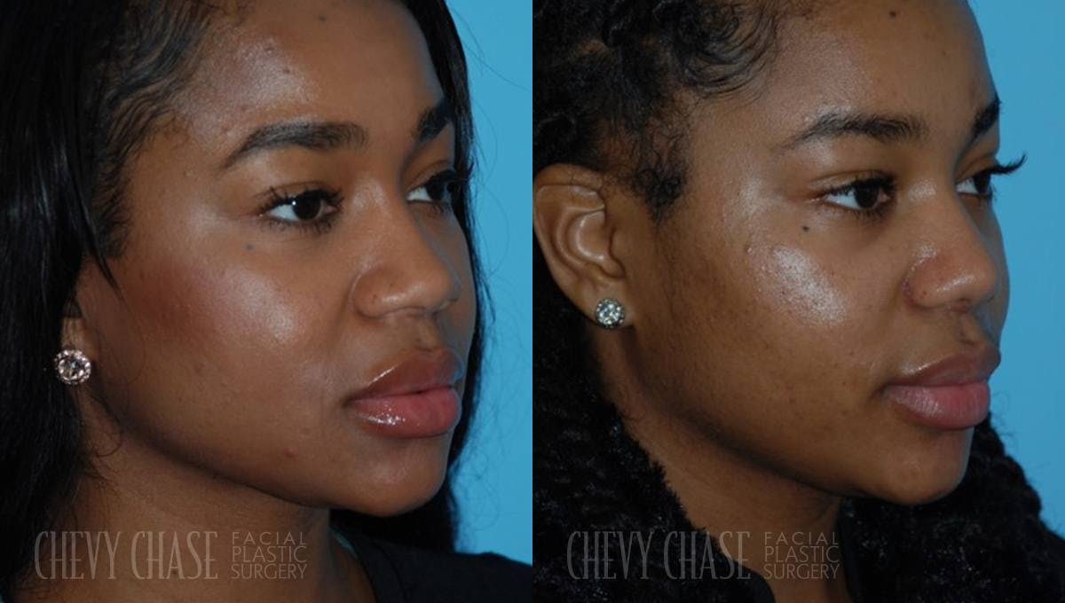 Rhinoplasty Before & After Gallery - Patient 106387678 - Image 2