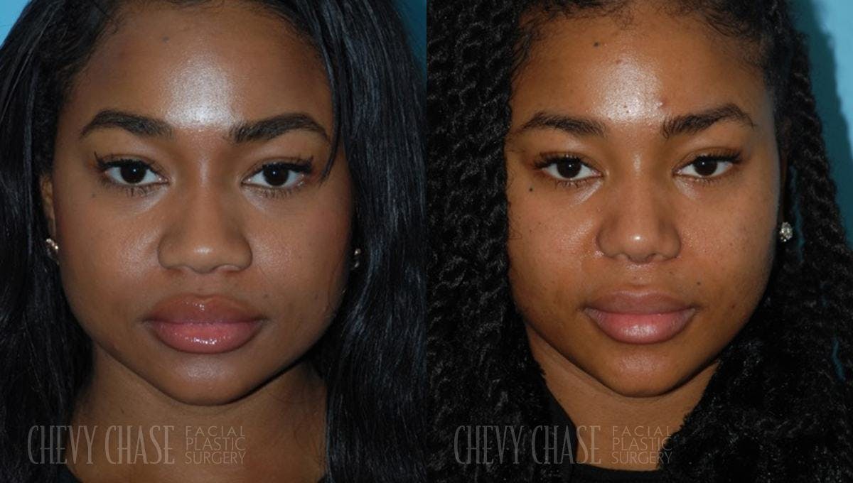 Rhinoplasty Before & After Gallery - Patient 106387678 - Image 3