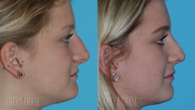Rhinoplasty Before & After Gallery - Patient 106387690 - Image 1