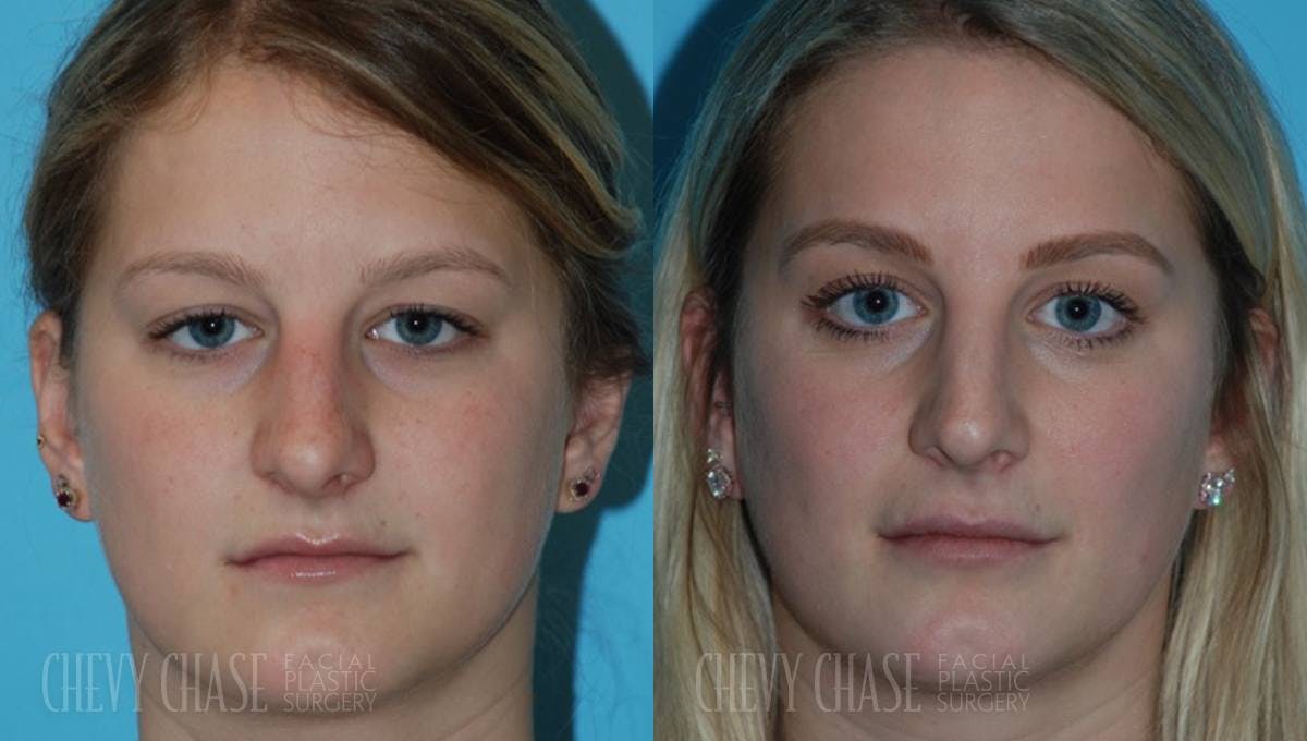 Rhinoplasty Before & After Gallery - Patient 106387690 - Image 2