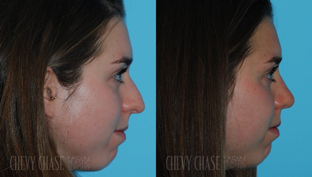 Rhinoplasty Before & After Gallery - Patient 106387691 - Image 1