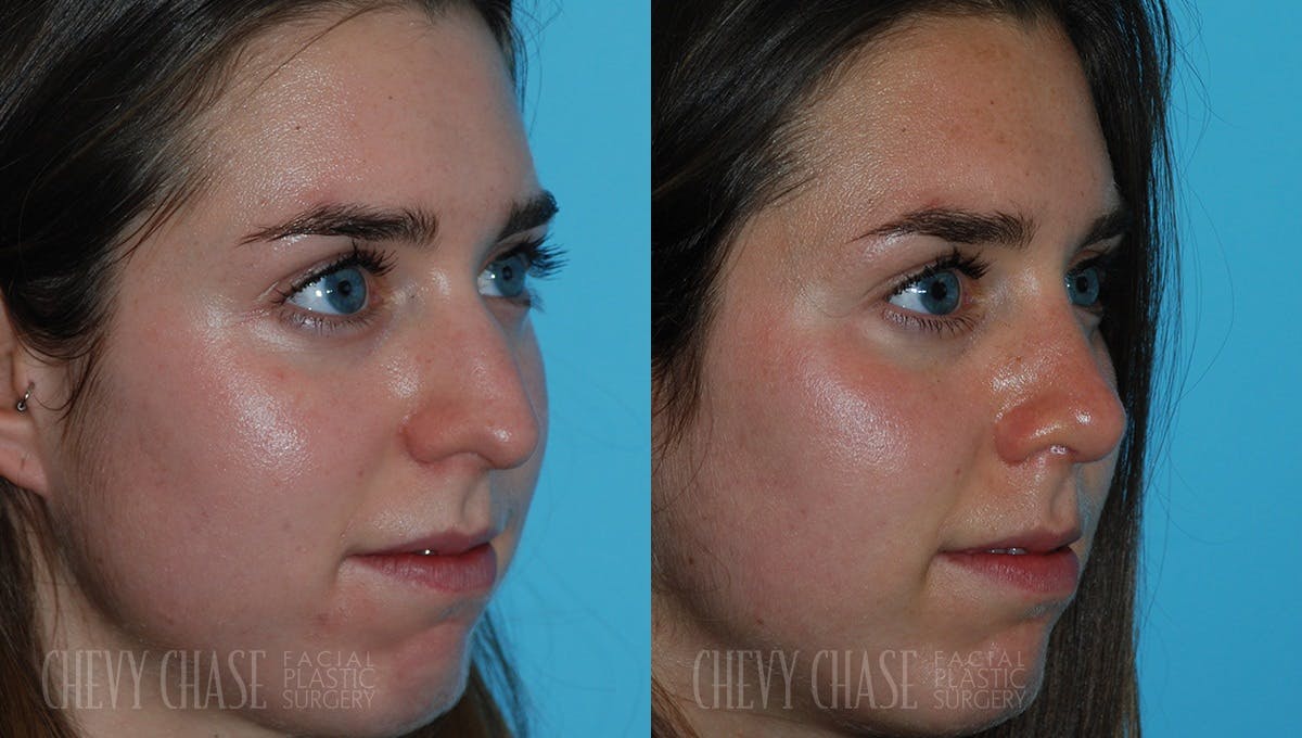 Rhinoplasty Before & After Gallery - Patient 106387691 - Image 2