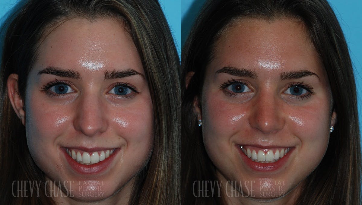 Rhinoplasty Before & After Gallery - Patient 106387691 - Image 3