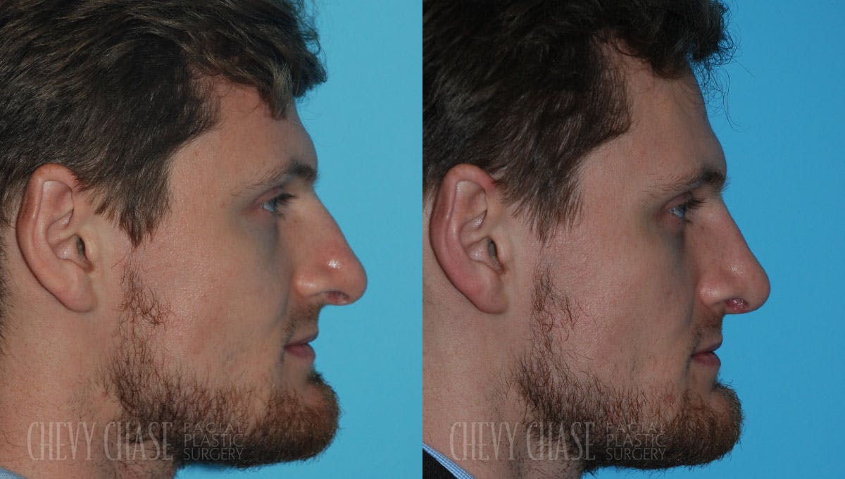 Rhinoplasty Before & After Gallery - Patient 106387699 - Image 1