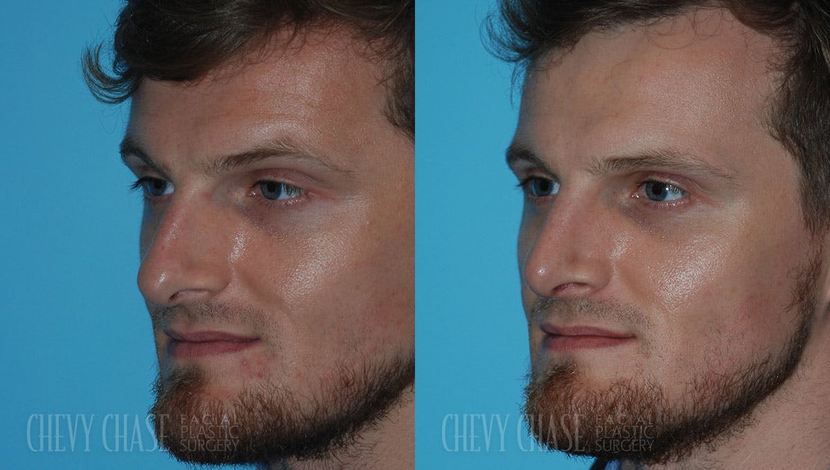 Rhinoplasty Before & After Gallery - Patient 106387699 - Image 2