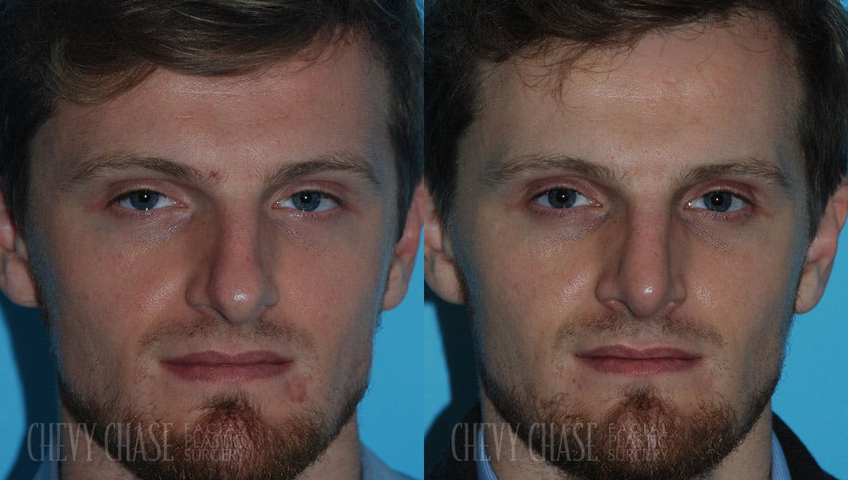 Rhinoplasty Before & After Gallery - Patient 106387699 - Image 3