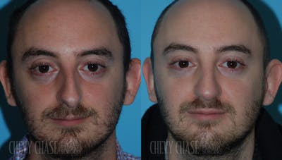 Rhinoplasty Before & After Gallery - Patient 106387700 - Image 1