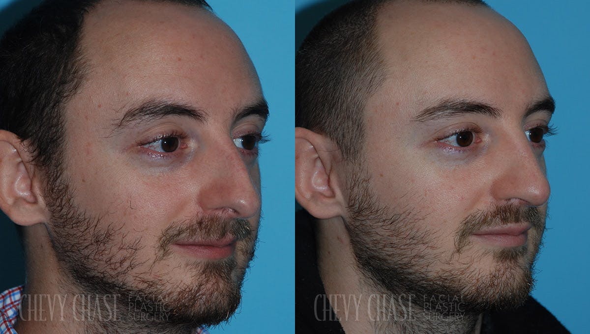 Rhinoplasty Before & After Gallery - Patient 106387700 - Image 2