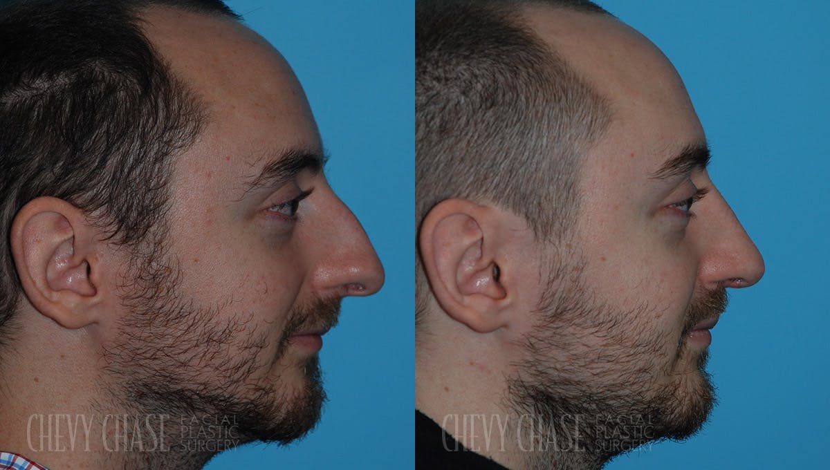 Rhinoplasty Before & After Gallery - Patient 106387700 - Image 3