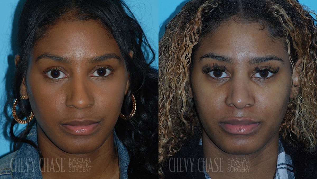 Rhinoplasty Before & After Gallery - Patient 106387703 - Image 1