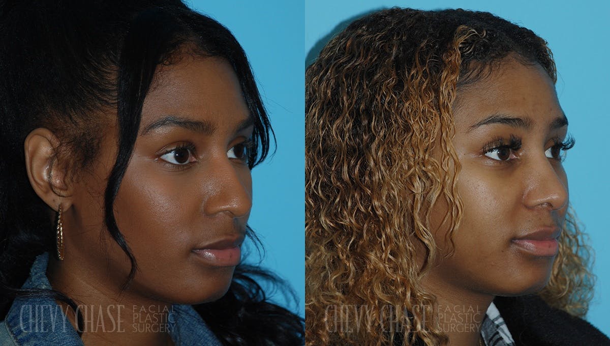 Rhinoplasty Before & After Gallery - Patient 106387703 - Image 2
