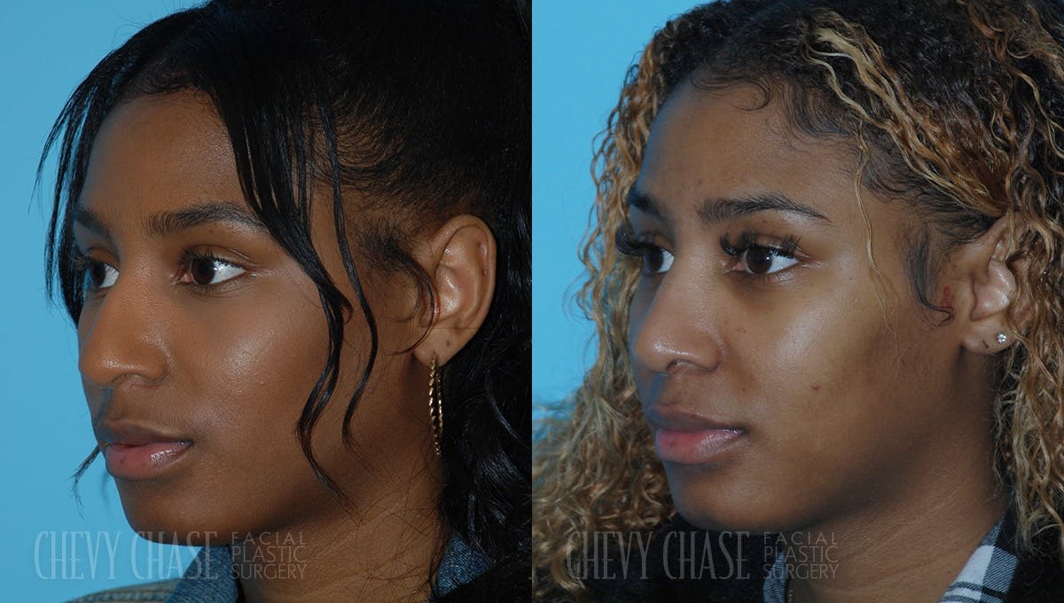 Rhinoplasty Before & After Gallery - Patient 106387703 - Image 3