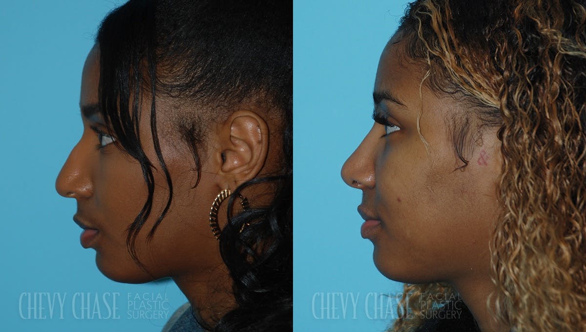 Rhinoplasty Before & After Gallery - Patient 106387703 - Image 4