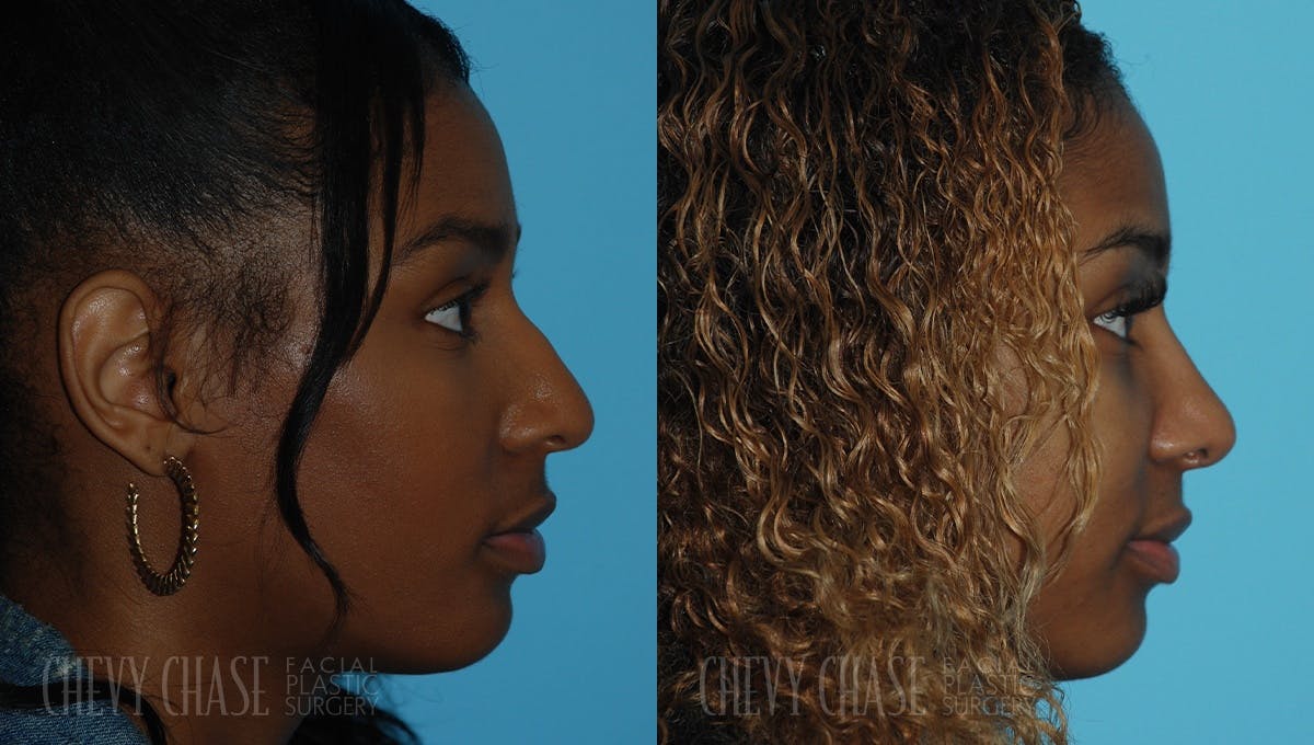 Rhinoplasty Before & After Gallery - Patient 106387703 - Image 5
