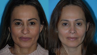 Rhinoplasty Before & After Gallery - Patient 106387707 - Image 1