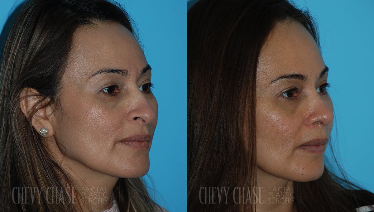Rhinoplasty Before & After Gallery - Patient 106387707 - Image 2