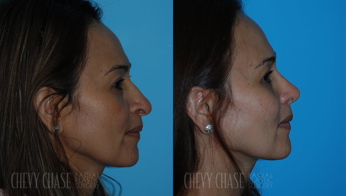 Rhinoplasty Before & After Gallery - Patient 106387707 - Image 3