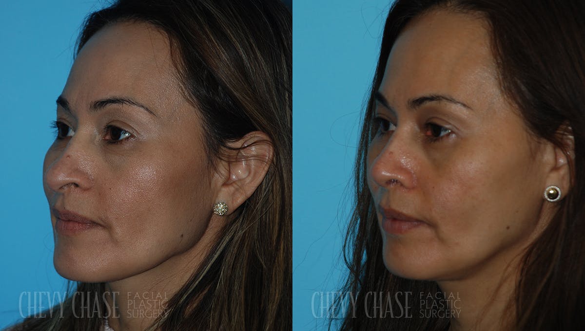 Rhinoplasty Before & After Gallery - Patient 106387707 - Image 4