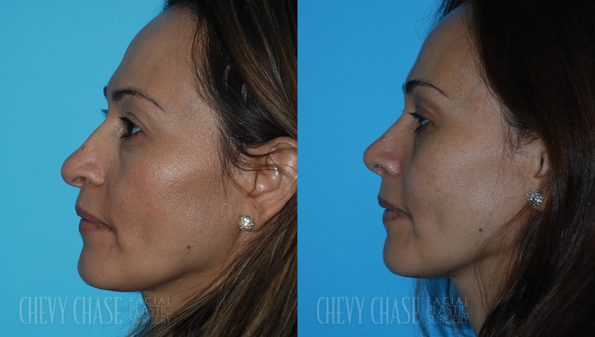 Rhinoplasty Before & After Gallery - Patient 106387707 - Image 5