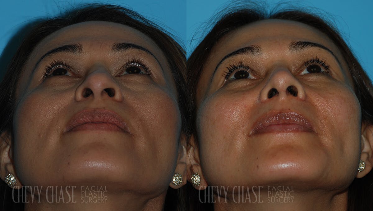 Rhinoplasty Before & After Gallery - Patient 106387707 - Image 6