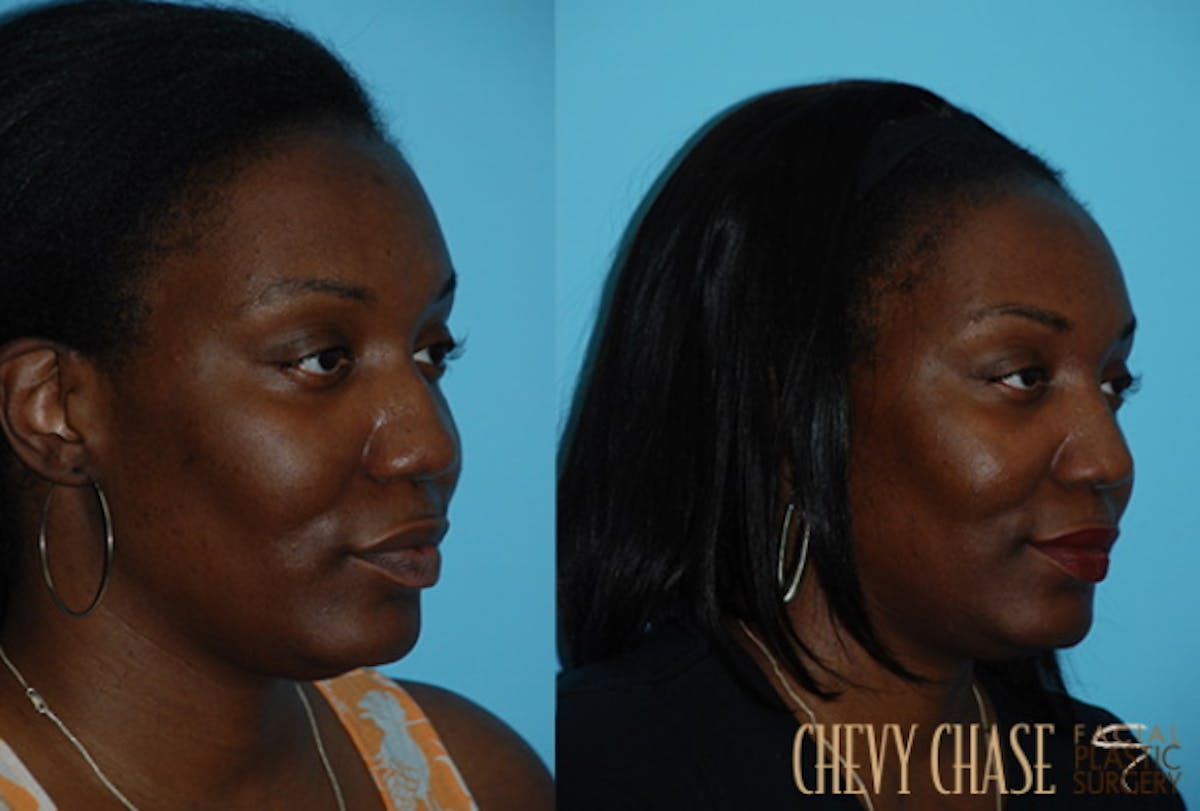 Rhinoplasty Before & After Gallery - Patient 106387708 - Image 2