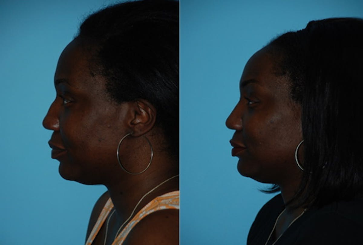 Rhinoplasty Before & After Gallery - Patient 106387708 - Image 3