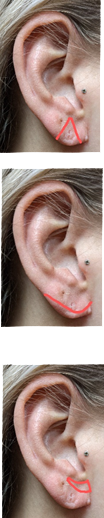 Ear Scars
