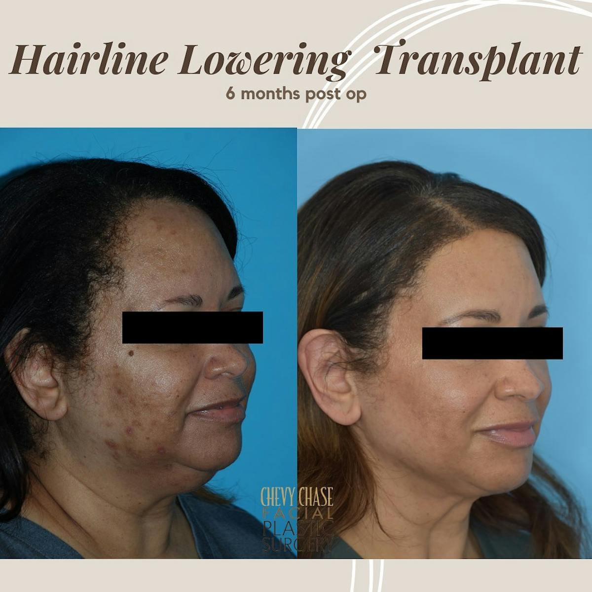 Hair Transplantation Before & After Gallery - Patient 106475489 - Image 2