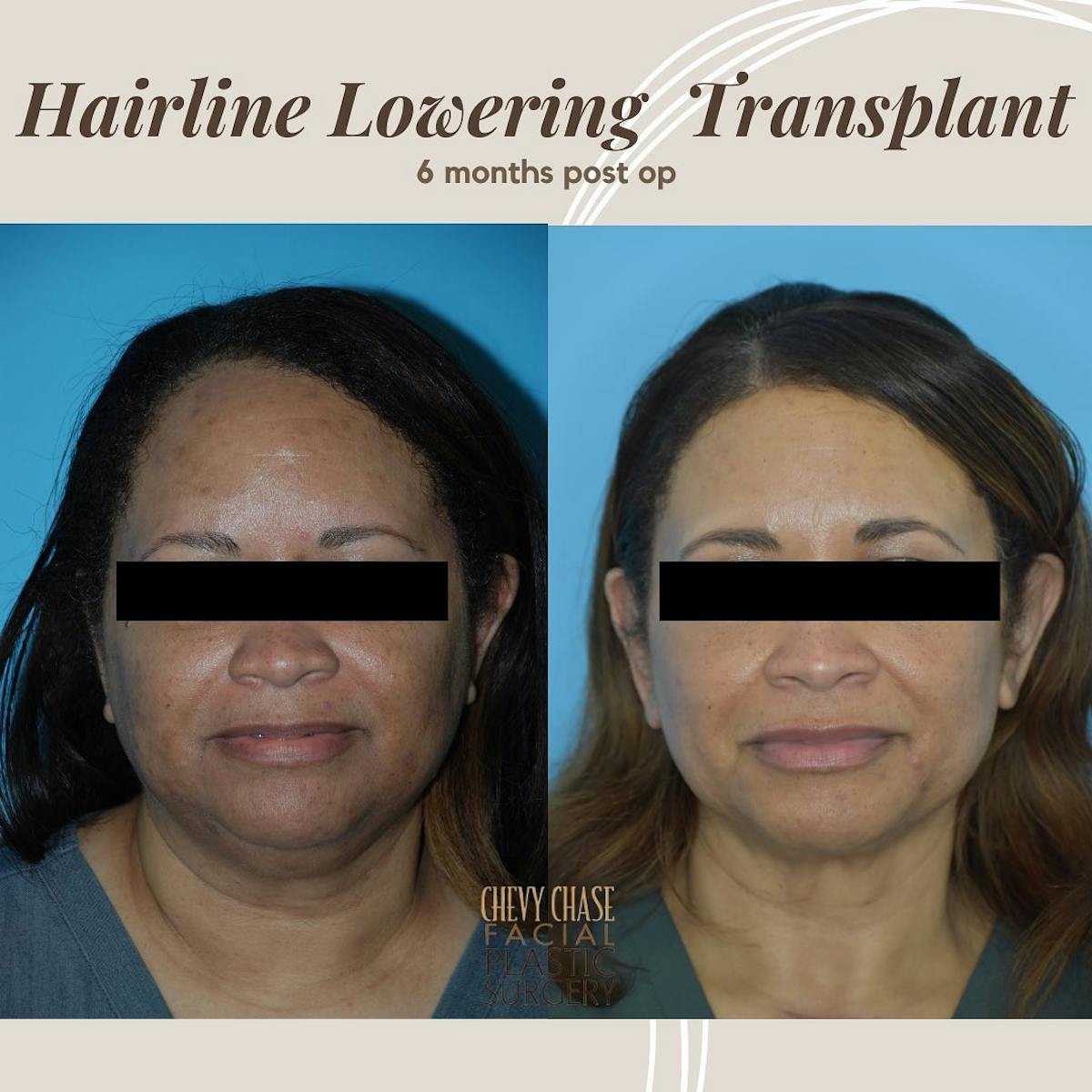 Hair Transplantation Before & After Gallery - Patient 106475489 - Image 1
