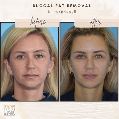 Buccal Fat Removal Before & After Gallery - Patient 106475526 - Image 1
