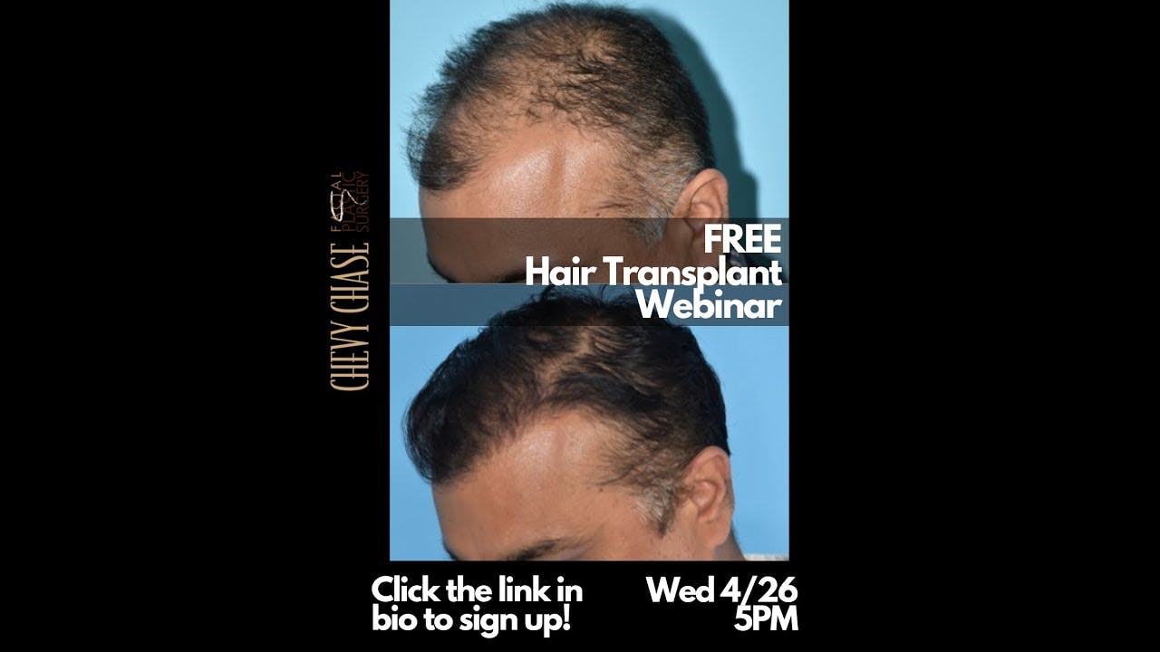 Chevy Chase Facial Plastic Surgery's hair transplantation webinar