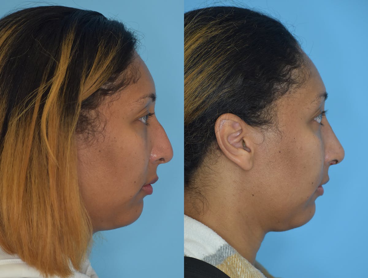 Rhinoplasty Before & After Gallery - Patient 180383013 - Image 5