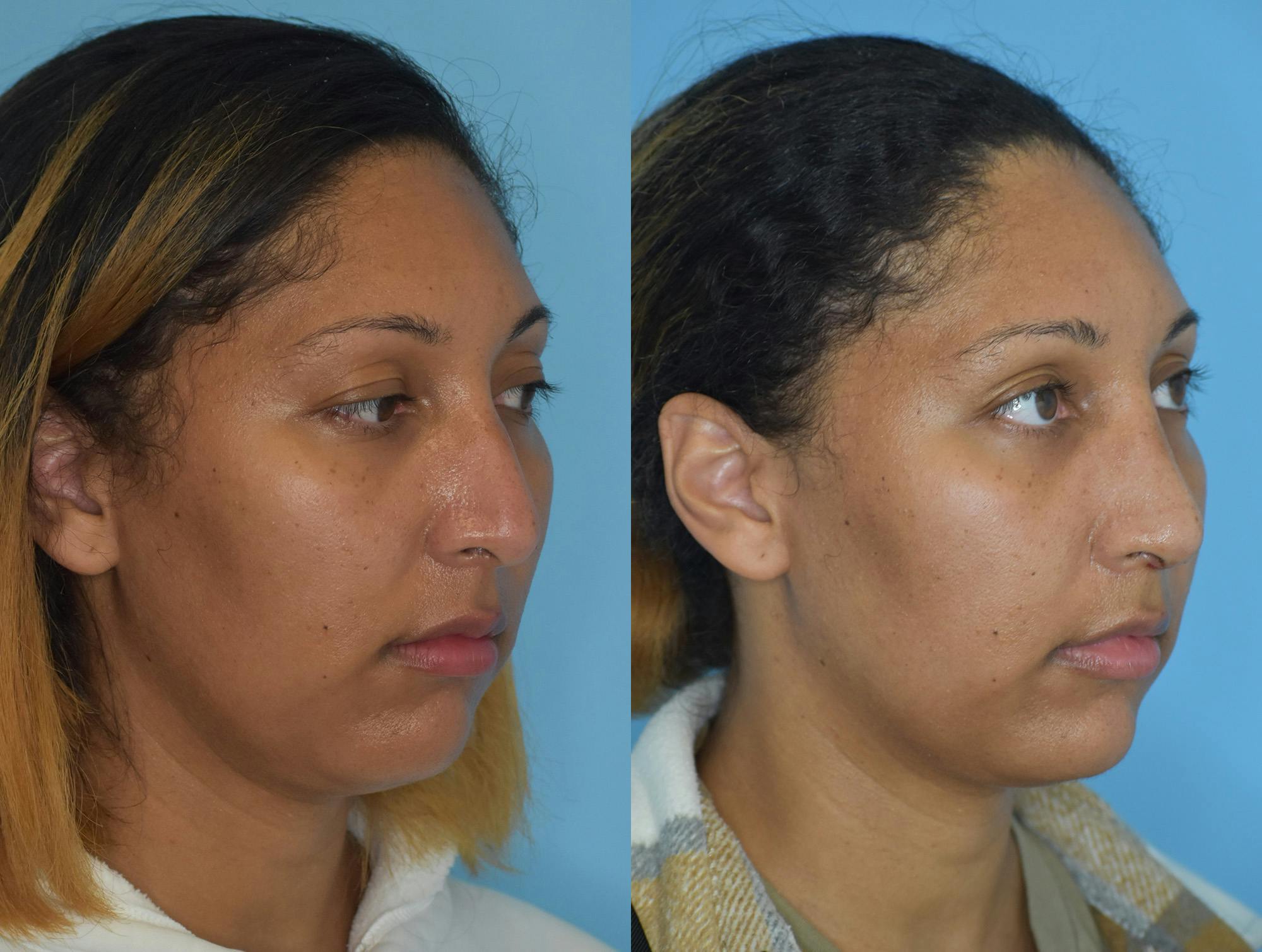 Rhinoplasty Before & After Gallery - Patient 180383013 - Image 4