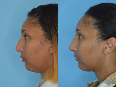 Rhinoplasty Before & After Gallery - Patient 180383013 - Image 1