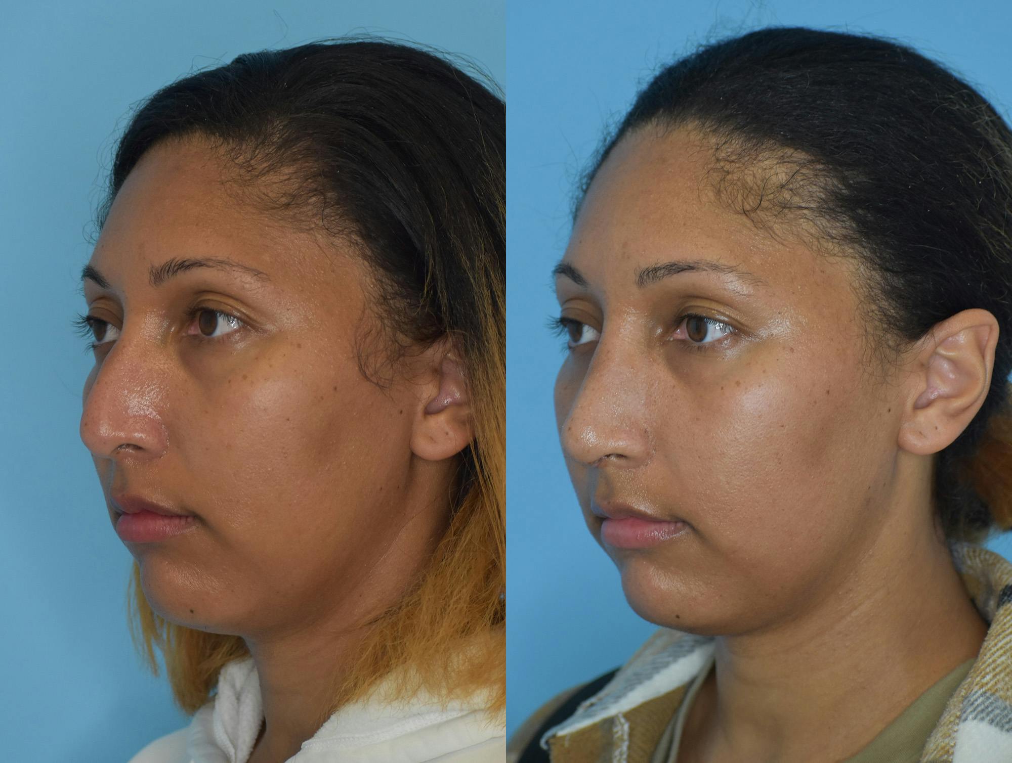 Rhinoplasty Before & After Gallery - Patient 180383013 - Image 2