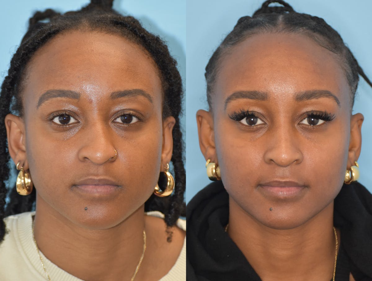 Rhinoplasty Before & After Gallery - Patient 180383012 - Image 3