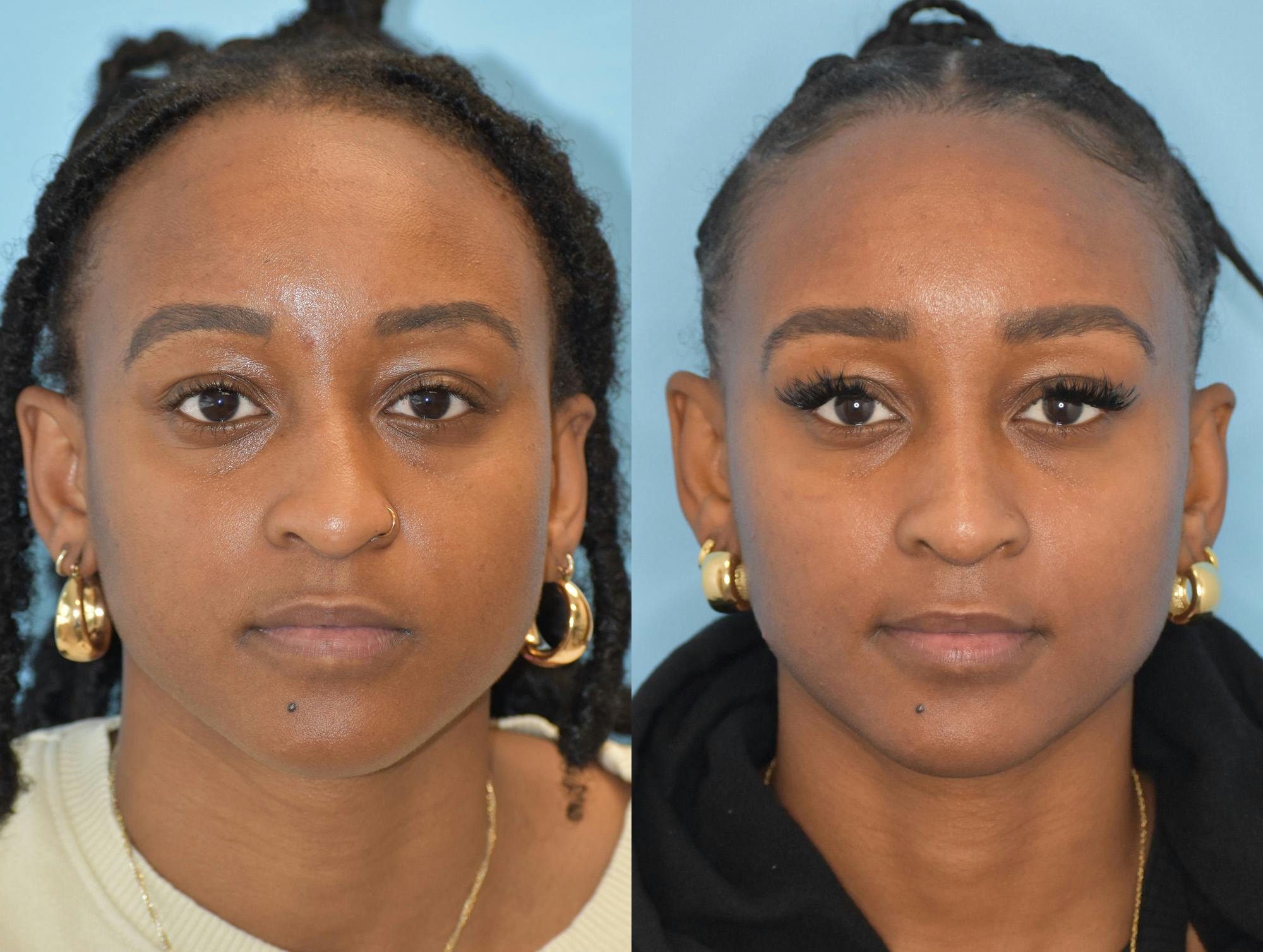 Rhinoplasty Before & After Gallery - Patient 180383012 - Image 3