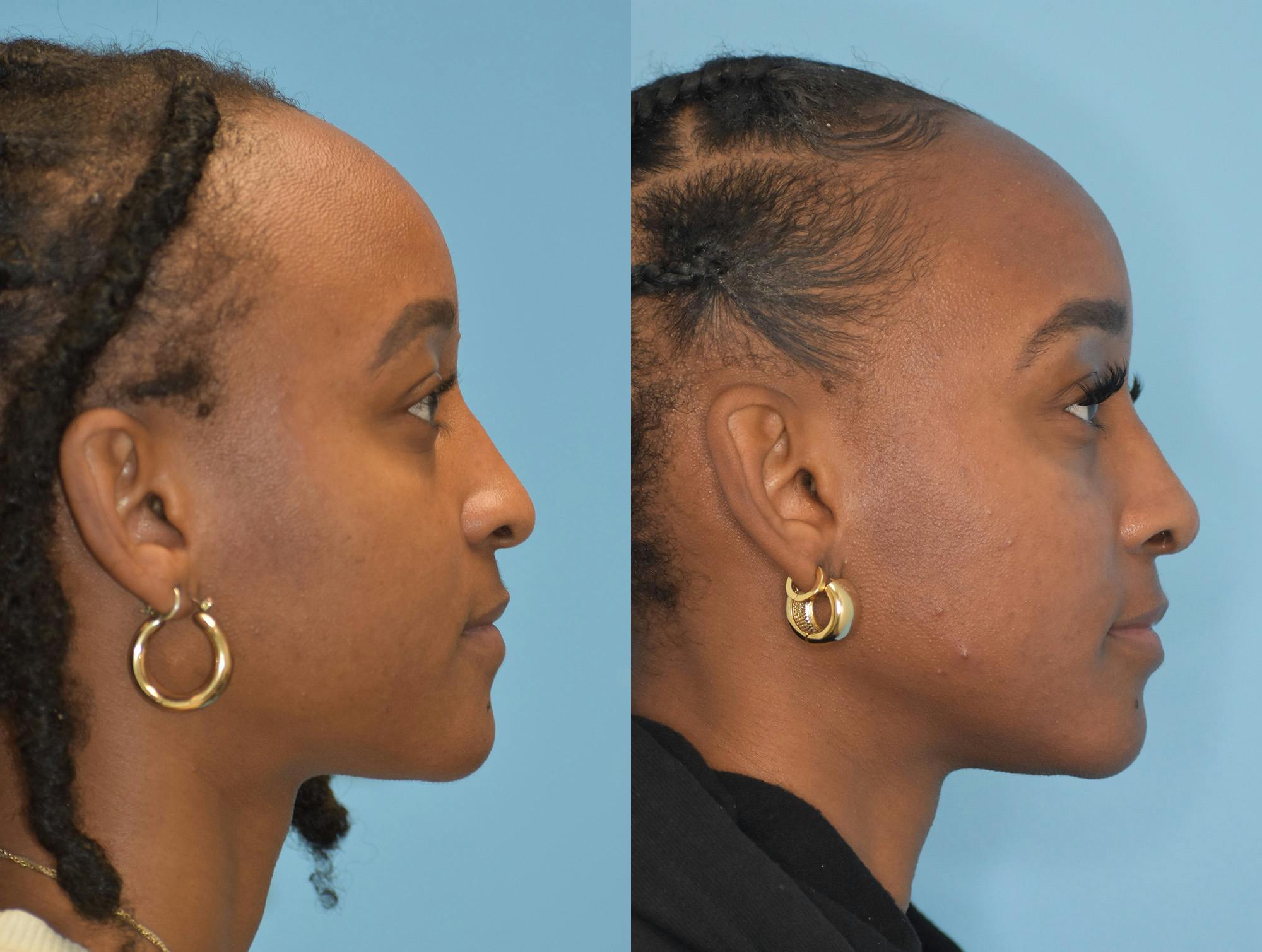 Rhinoplasty Before & After Gallery - Patient 180383012 - Image 5