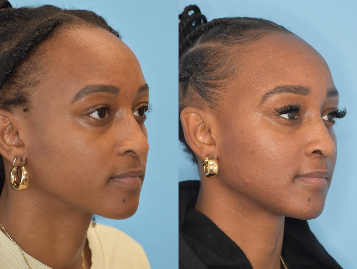 Rhinoplasty Before & After Gallery - Patient 180383012 - Image 4