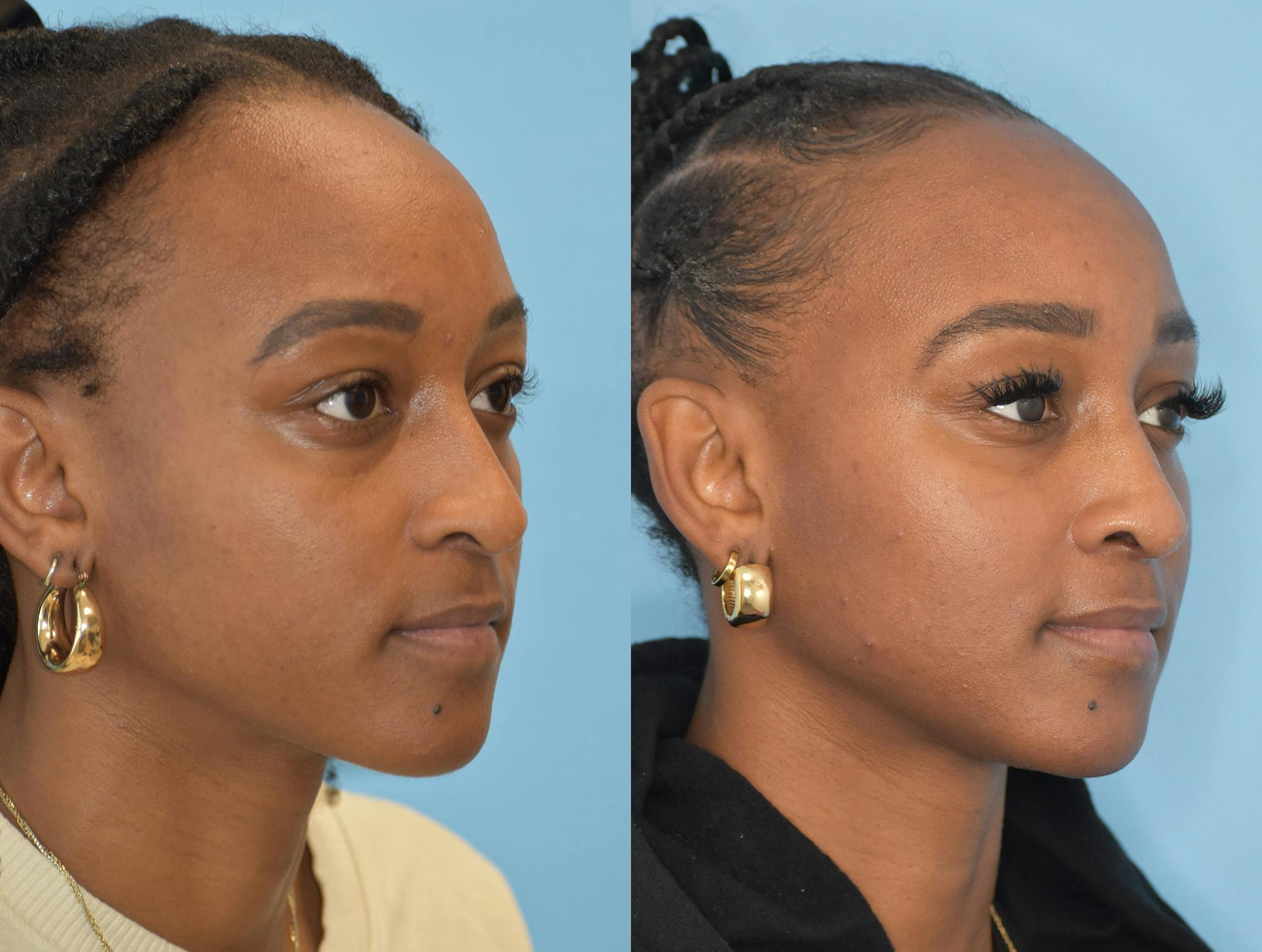 Rhinoplasty Before & After Gallery - Patient 180383012 - Image 4