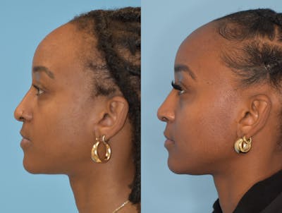 Rhinoplasty Before & After Gallery - Patient 180383012 - Image 1