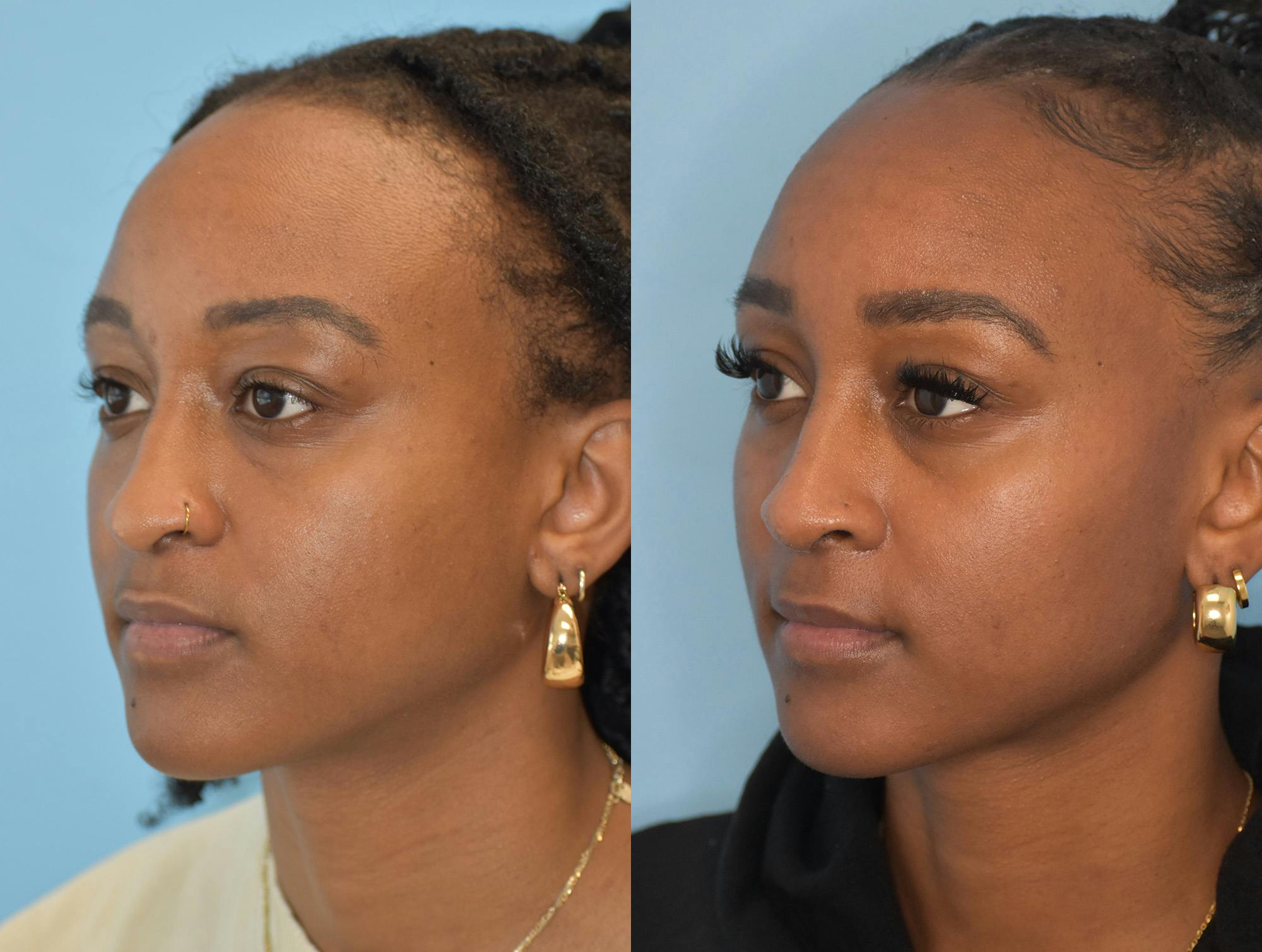 Rhinoplasty Before & After Gallery - Patient 180383012 - Image 2