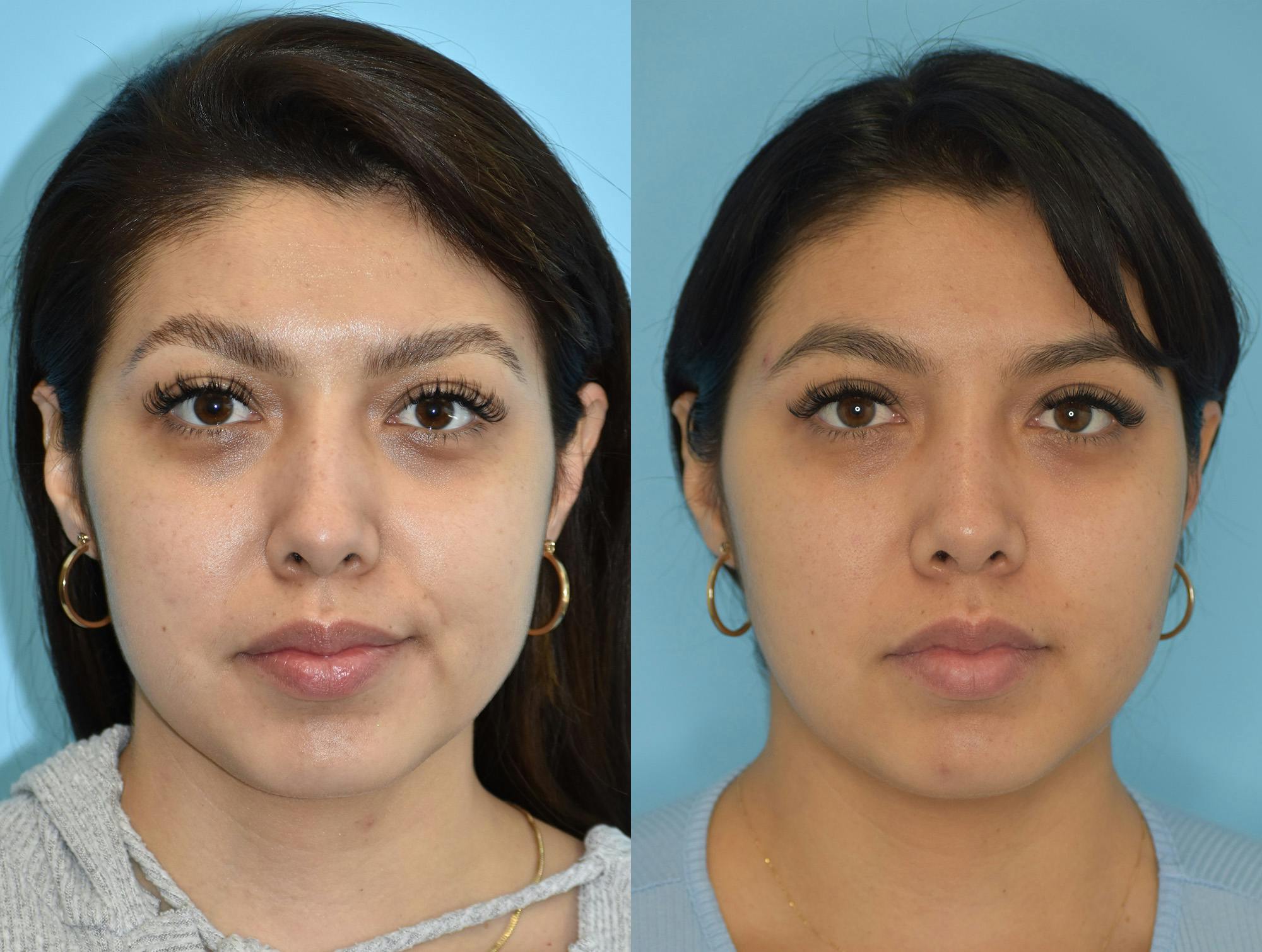 Rhinoplasty Before & After Gallery - Patient 180383011 - Image 3