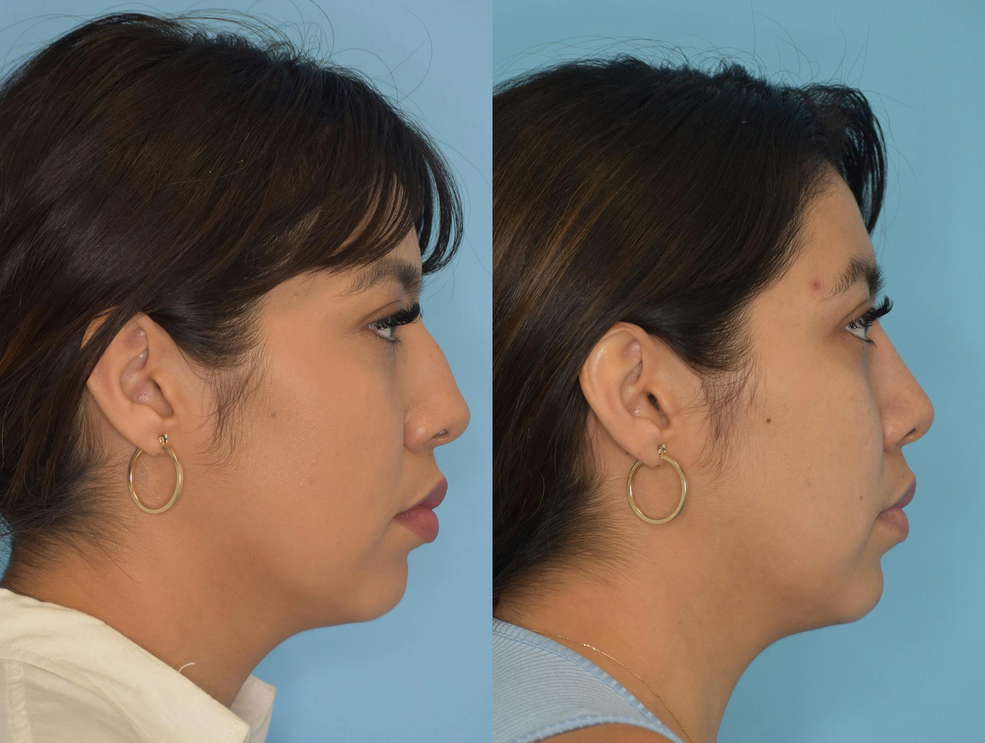 Rhinoplasty Before & After Gallery - Patient 180383011 - Image 5