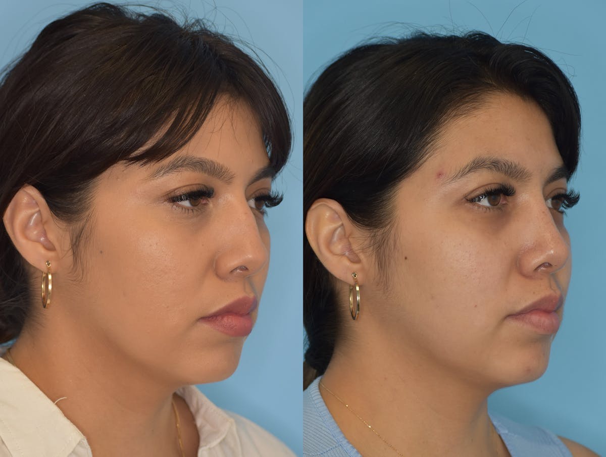 Rhinoplasty Before & After Gallery - Patient 180383011 - Image 4