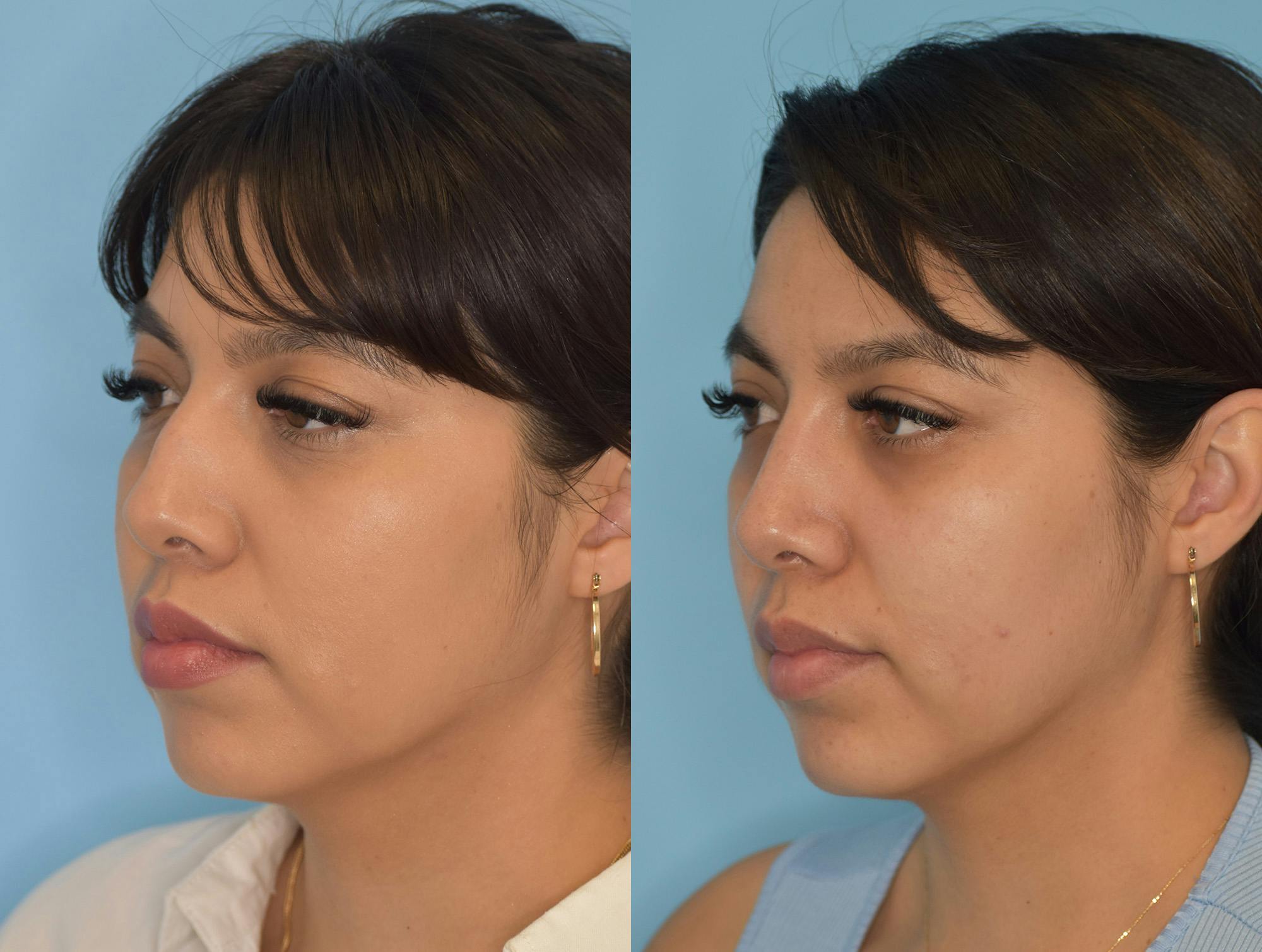 Rhinoplasty Before & After Gallery - Patient 180383011 - Image 2