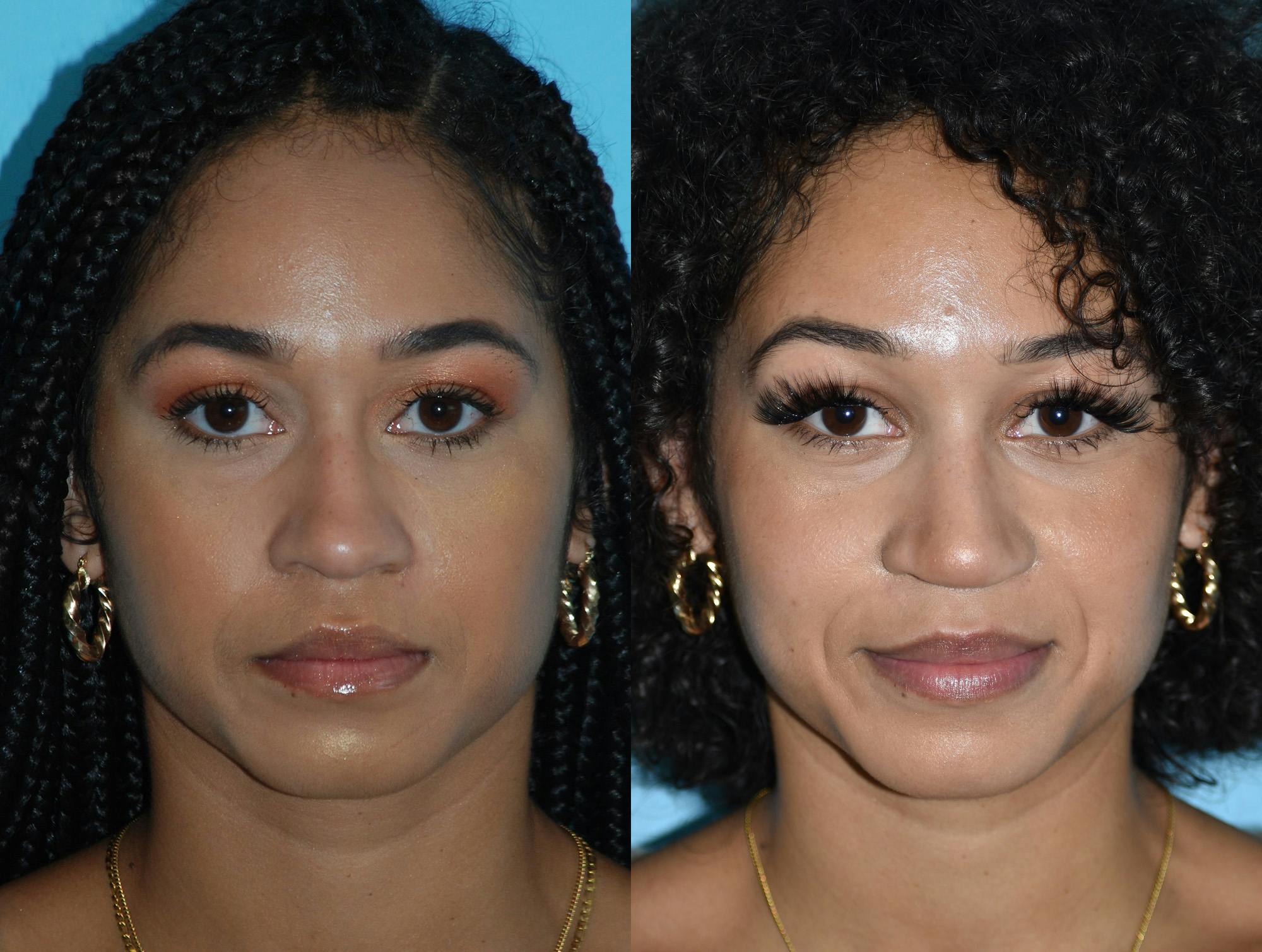 Rhinoplasty Before & After Gallery - Patient 180383015 - Image 3