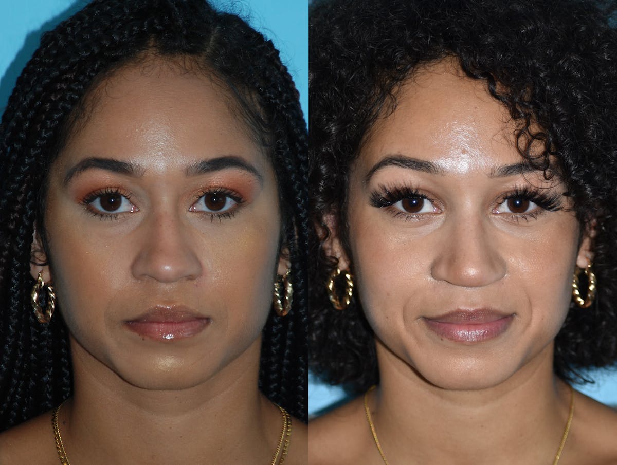 Rhinoplasty Before & After Gallery - Patient 180383015 - Image 3