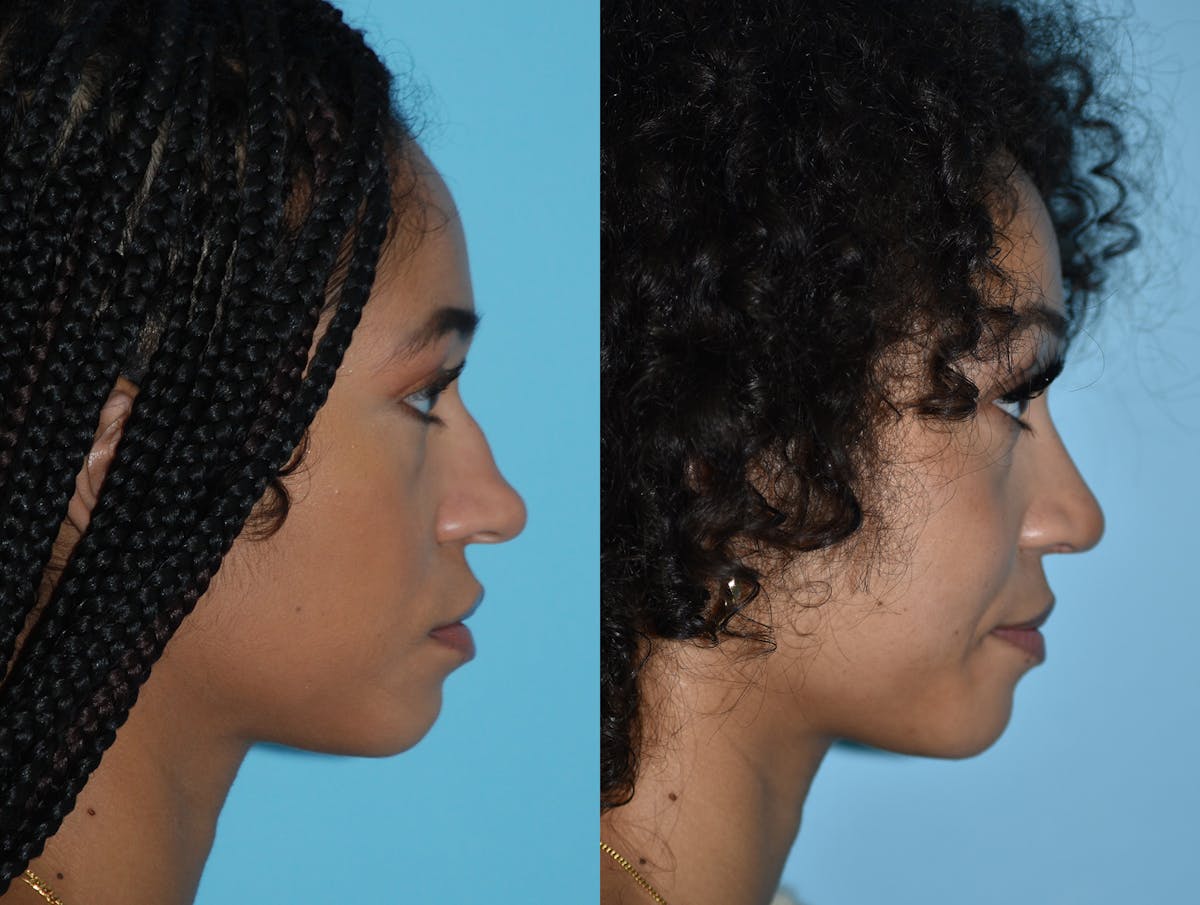 Rhinoplasty Before & After Gallery - Patient 180383015 - Image 5