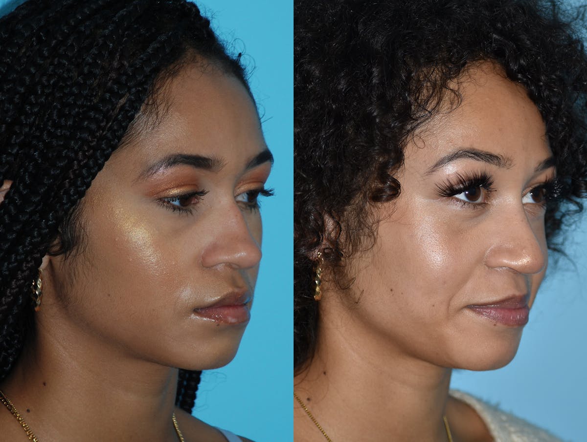 Rhinoplasty Before & After Gallery - Patient 180383015 - Image 4